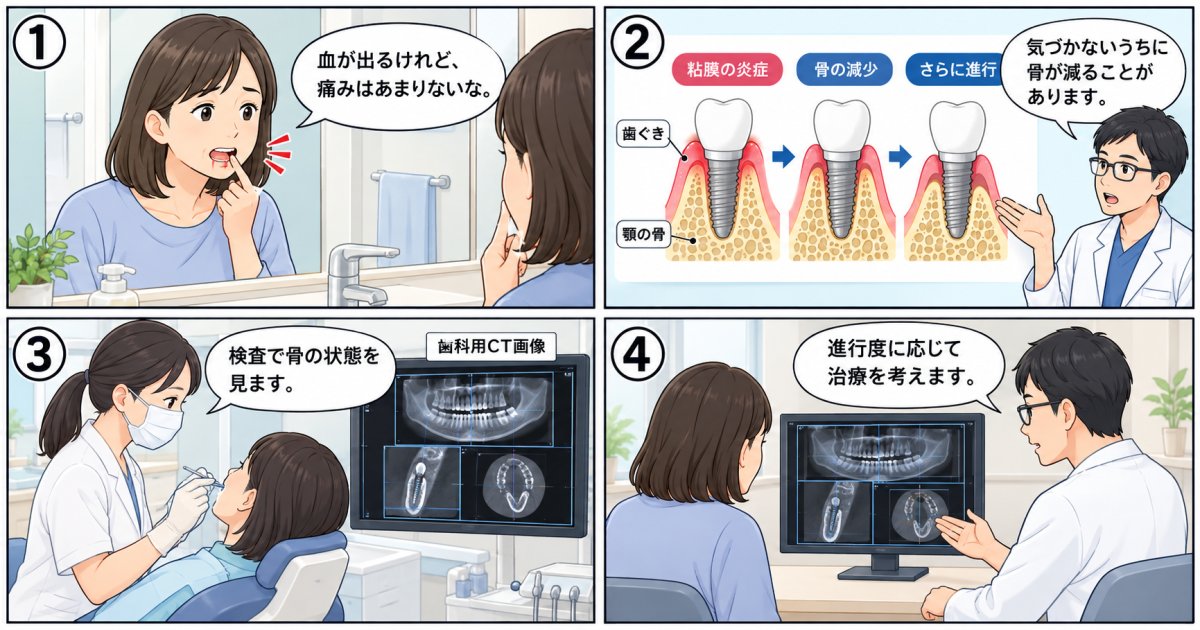 インプラント周囲炎を放置すると起きる骨の吸収と残せる段階での治療法